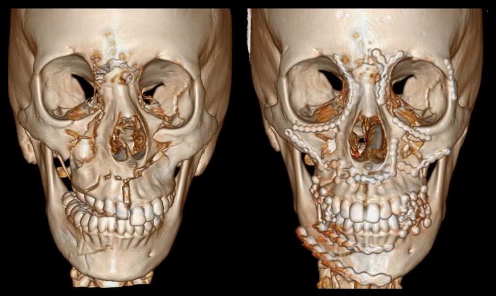 bone fractures in face